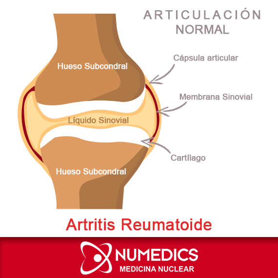 Daño ocasionado por Artritis Reumatoide