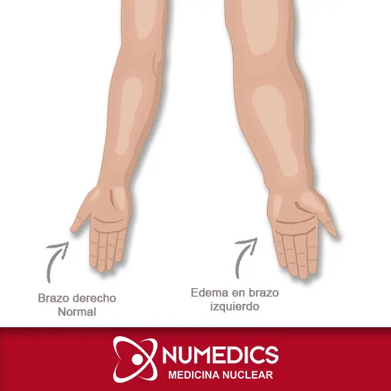 Edema en brazo isquierdo