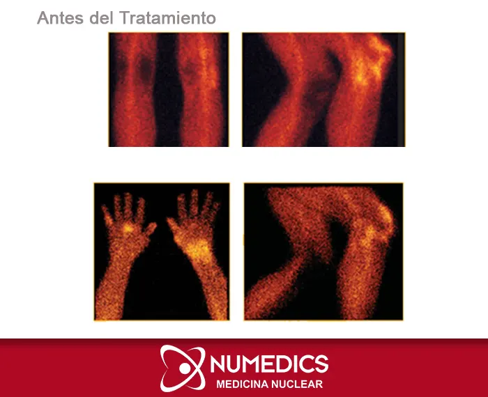 Tratamiento para artritis