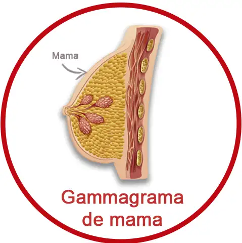 Gammagrama de mama