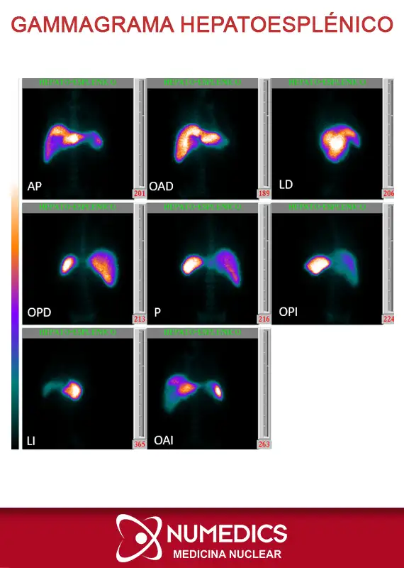 Gammagrama Hepatoesplénico