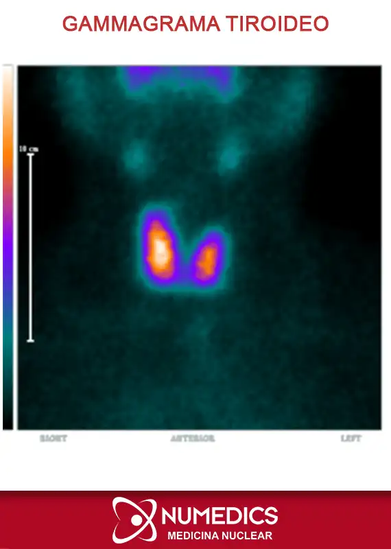 Gammagrafía Tiroidea
