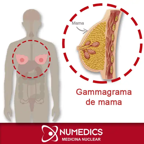 Gammagrafía de mama