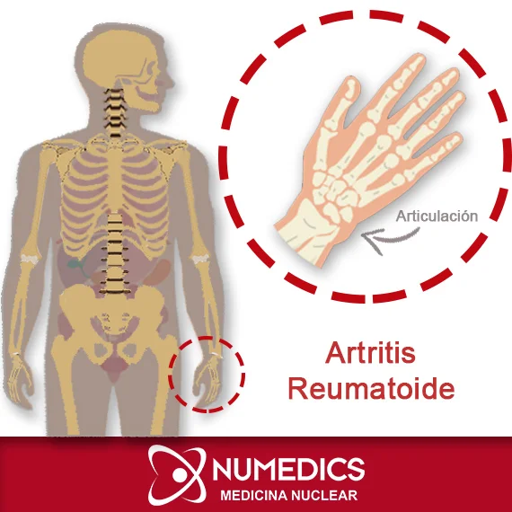 Artritis Reumatoide